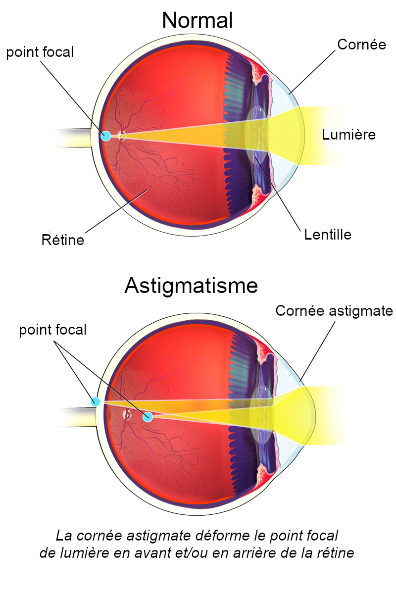 Astigmatisme (Oeil)